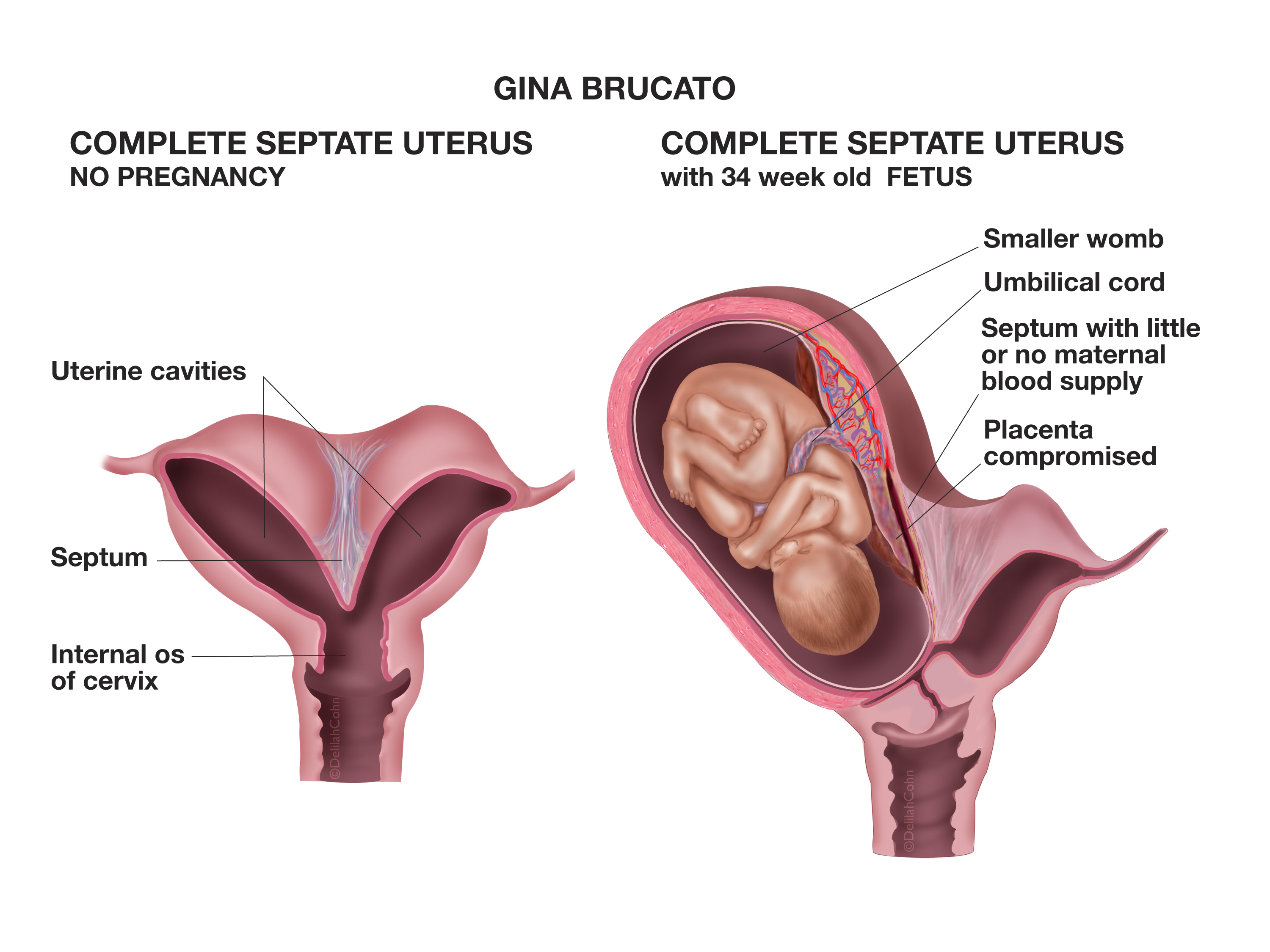 endometrial-thickness-what-is-the-normal-range